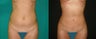 30 Year Old female; Liposculpture + Breast augmentation + Fat grafting