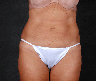 CoolSculpting by Zeltiq