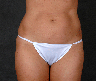 CoolSculpting by Zeltiq