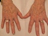 IPL to the hands