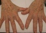 IPL to the hands