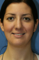 Chin/Neck Liposuction