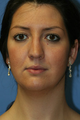 Chin/Neck Liposuction