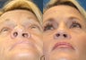 Revision Rhinoplasty