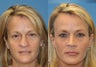 Revision Rhinoplasty