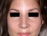 Rhinoplasty (Nose Reshaping)
