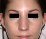 Rhinoplasty (Nose Reshaping)