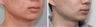 Buccal Fat Before and 2 Month After