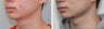 Buccal Fat Before and 2 Month After