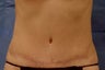 Abdominoplasty (Tummy Tuck)