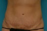 Abdominoplasty (Tummy Tuck)
