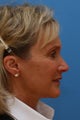 Middle Age Lady - Facelift