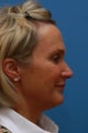 Middle Age Lady - Facelift