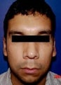 Ear Surgery - Otoplasty