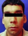 Ear Surgery - Otoplasty
