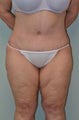 Lower body lift