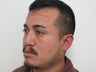 Secondary Cleft Lip and Cleft Rhinoplasty Revision