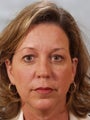 Upper Blepharoplasty