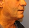 Ultherapy