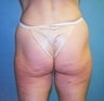 51 year old female patient