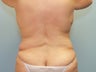 Patient treated for Vaser Lipo of the back