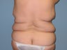 Patient treated for Vaser Lipo of the back