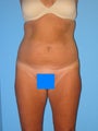 46 Year Old Female
