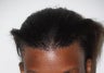 Hairline Advancement with Tissue Expander