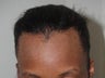 Hairline Advancement with Tissue Expander