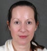 Eyelid Surgery