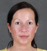 Eyelid Surgery