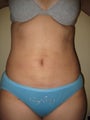 29 year old female before and after SmartLipo of the abdomen