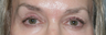 Fraxel Repair to Brighten Eye Area
