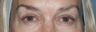 Fraxel Repair to Brighten Eye Area