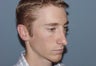 Correction of excessively thinned out nose following primary nasal surgery