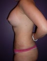 Laser Liposuction