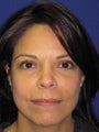 Facial Fat Grafting