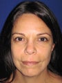 Facial Fat Grafting