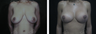 35 y/o patient who underwent a Breast Lift without implants