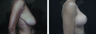 35 y/o patient who underwent a Breast Lift without implants
