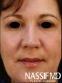 Female Primary Rhinoplasty