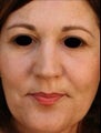 Female Primary Rhinoplasty