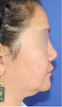 Revision Asian Rhinoplasty