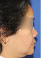 Revision Asian Rhinoplasty