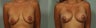 Breast lift and augmentation