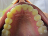 Incisor sticking out with misshapen front teeth