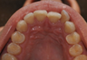 Incisor sticking out with misshapen front teeth