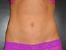 Smartlipo MPX