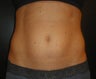 Smartlipo MPX