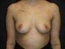 Breast reconstruction - Implants